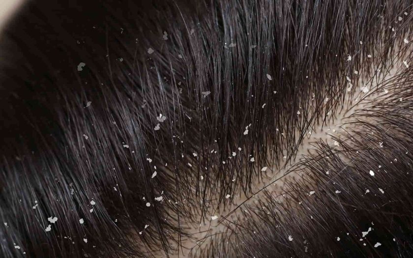 dandruff